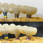 純正アバットメント加工